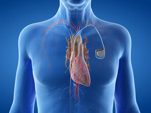 [Translate to English:] Implantation de stimulateur cardiaque